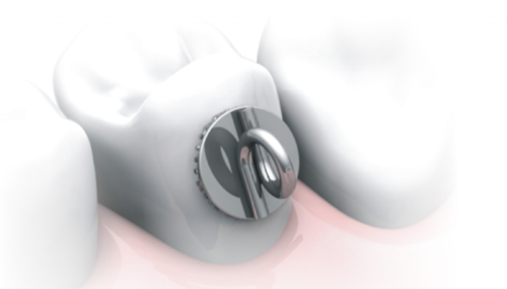 Colagem de braquetes ortodônticos em dentes inclusos.