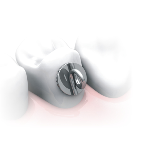 Colagem de braquetes ortodônticos em dentes inclusos.