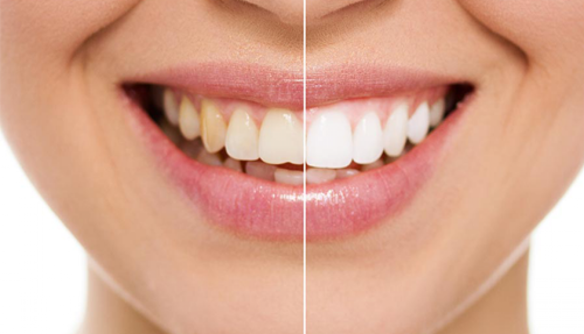 Quais os dentes não respondem ao clareamento dental